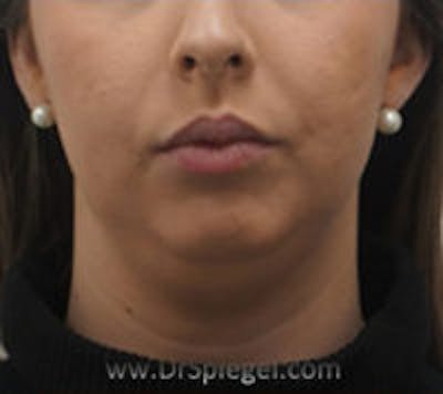 Chin Augmentation Before & After Gallery - Patient 305825 - Image 1