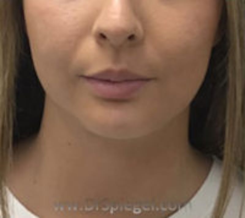 Chin Augmentation Before & After Gallery - Patient 305825 - Image 2