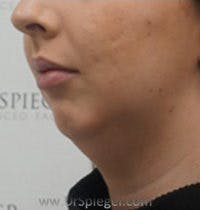 Chin Augmentation Before & After Gallery - Patient 305825 - Image 3