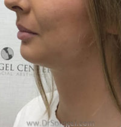 Chin Augmentation Before & After Gallery - Patient 305825 - Image 4