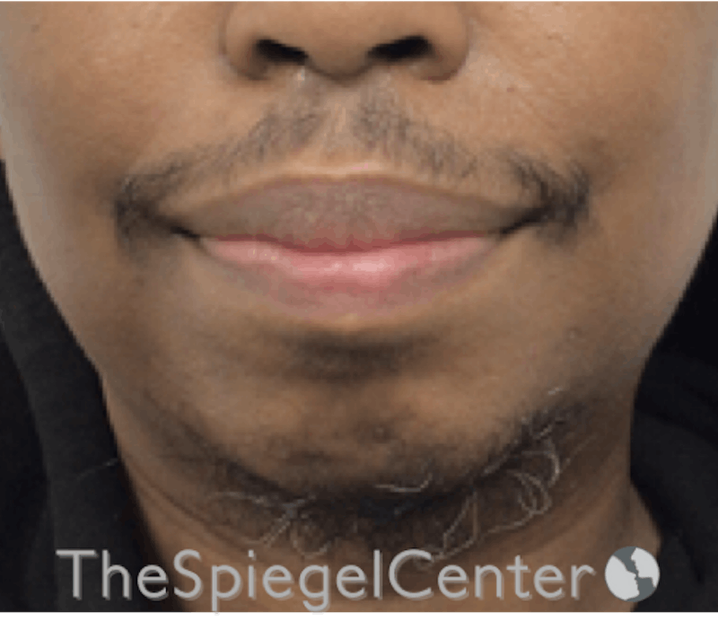 Chin Augmentation Before & After Gallery - Patient 283155 - Image 1