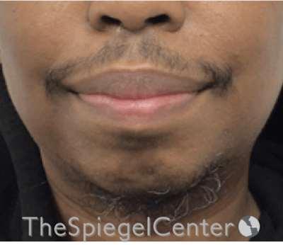 Chin Augmentation Before & After Gallery - Patient 283155 - Image 1