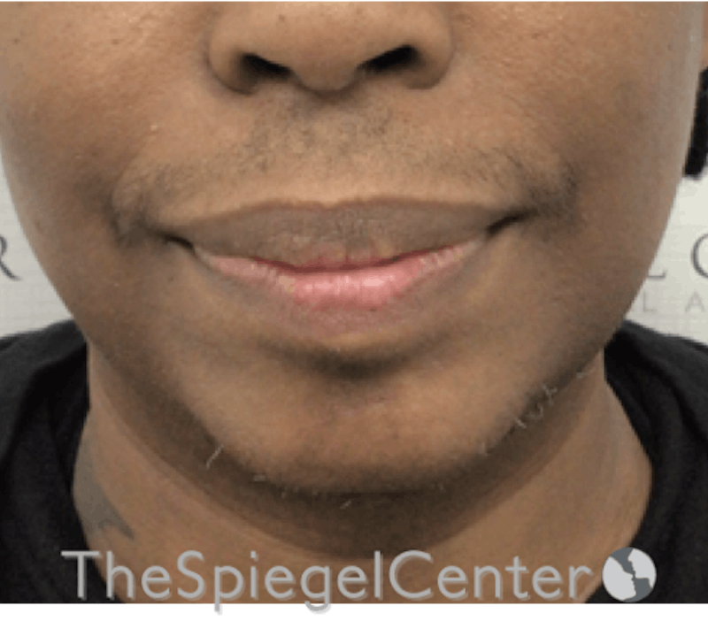 Chin Augmentation Before & After Gallery - Patient 283155 - Image 2