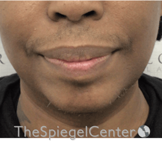 Chin Augmentation Before & After Gallery - Patient 283155 - Image 2