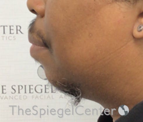 Chin Augmentation Before & After Gallery - Patient 283155 - Image 3