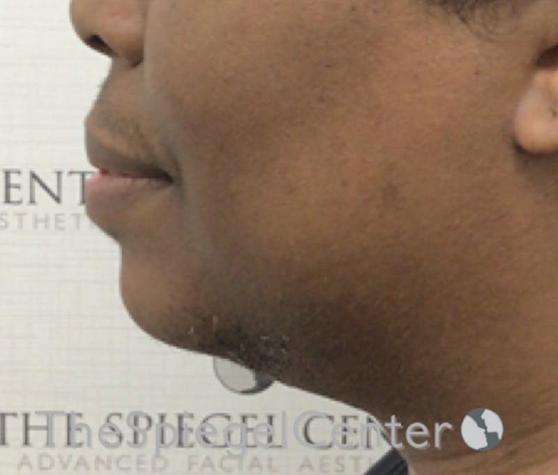 Chin Augmentation Before & After Gallery - Patient 283155 - Image 4