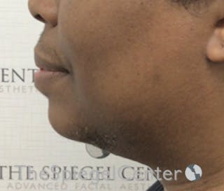 Chin Augmentation Before & After Gallery - Patient 283155 - Image 4