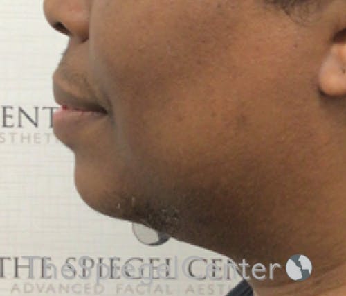 Chin Augmentation Before & After Gallery - Patient 283155 - Image 4