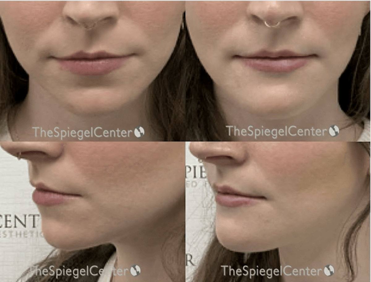 Chin Augmentation Before & After Gallery - Patient 428370 - Image 1