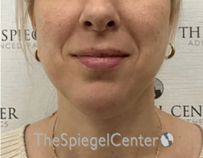 Chin Augmentation Before & After Gallery - Patient 550060 - Image 1