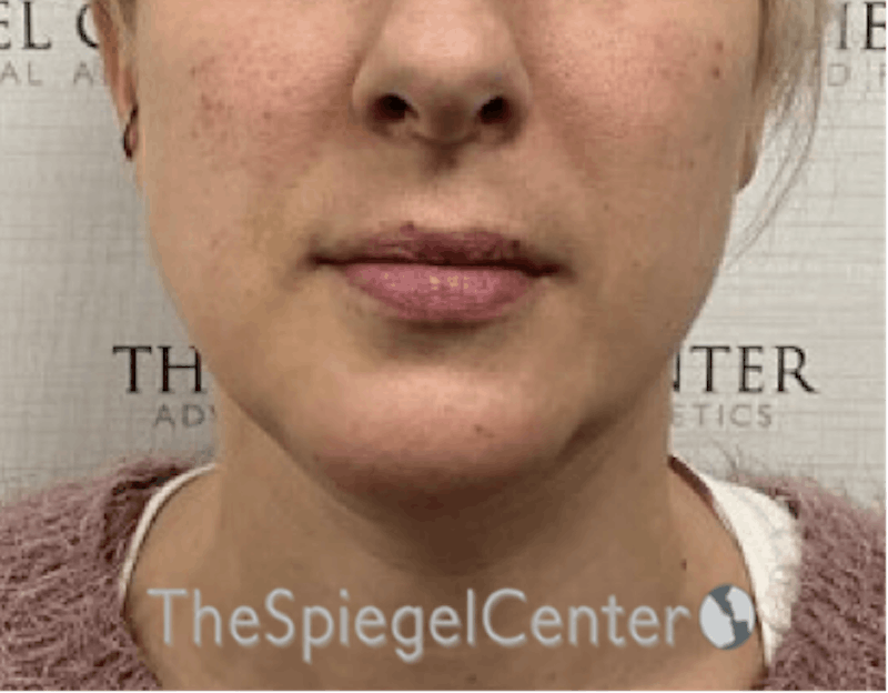Chin Augmentation Before & After Gallery - Patient 550060 - Image 2