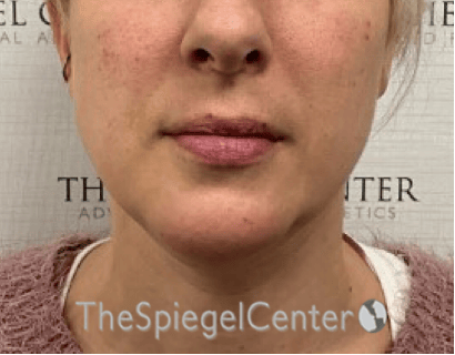 Chin Augmentation Before & After Gallery - Patient 550060 - Image 2