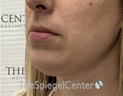 Chin Augmentation Before & After Gallery - Patient 550060 - Image 3