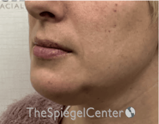 Chin Augmentation Before & After Gallery - Patient 550060 - Image 4