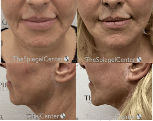 Chin Augmentation Before & After Gallery - Patient 149802 - Image 1