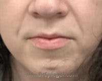 Chin Augmentation Before & After Gallery - Patient 309638 - Image 1