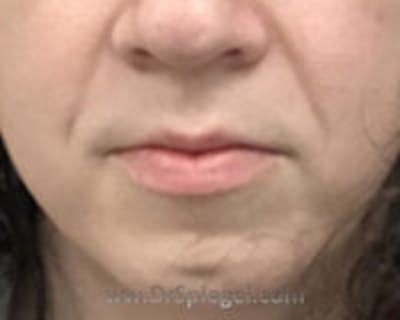 Chin Augmentation Before & After Gallery - Patient 309638 - Image 1