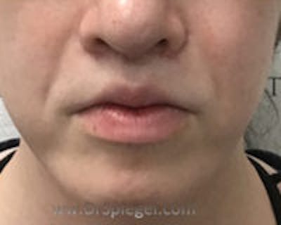 Chin Augmentation Before & After Gallery - Patient 309638 - Image 2