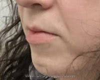 Chin Augmentation Before & After Gallery - Patient 309638 - Image 3