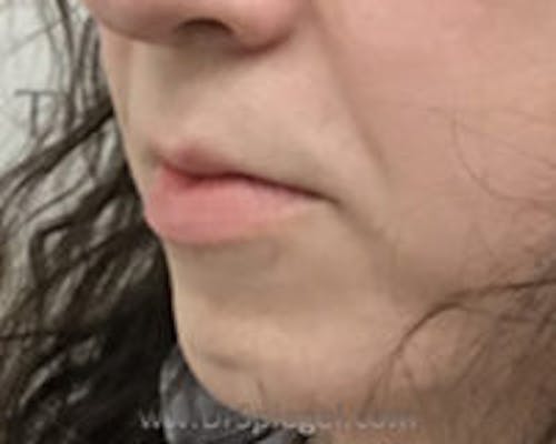 Chin Augmentation Before & After Gallery - Patient 309638 - Image 3