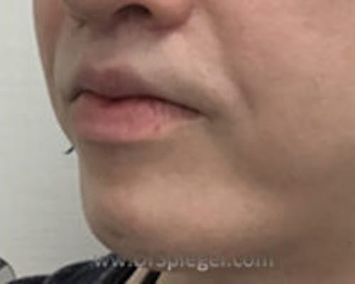 Chin Augmentation Before & After Gallery - Patient 309638 - Image 4