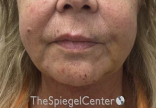 Chin Augmentation Before & After Gallery - Patient 366977 - Image 2