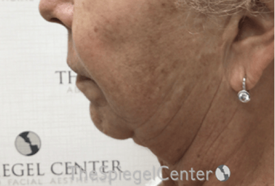 Chin Augmentation Before & After Gallery - Patient 366977 - Image 3
