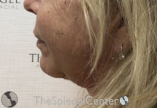 Chin Augmentation Before & After Gallery - Patient 366977 - Image 4