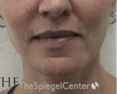Chin Augmentation Before & After Gallery - Patient 136170 - Image 1