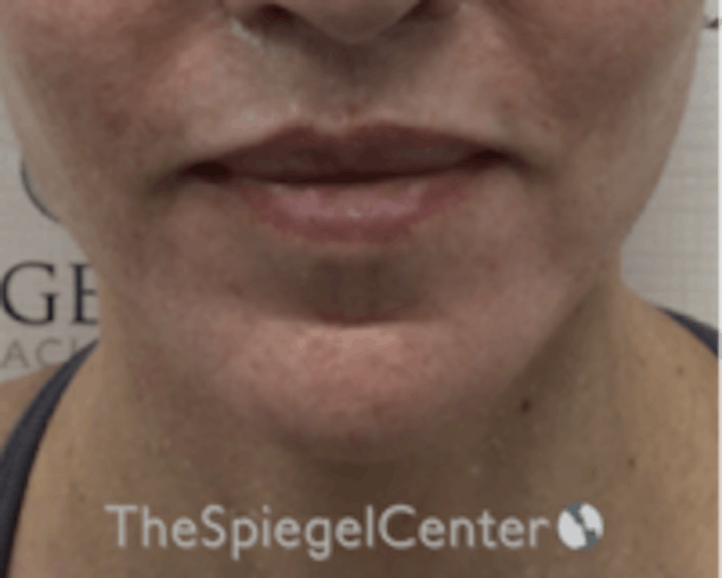 Chin Augmentation Before & After Gallery - Patient 136170 - Image 2
