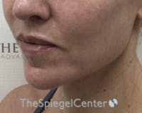 Chin Augmentation Before & After Gallery - Patient 136170 - Image 4
