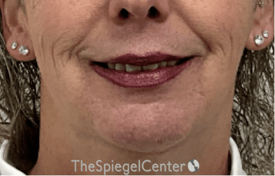 Chin Augmentation Before & After Gallery - Patient 191101 - Image 1