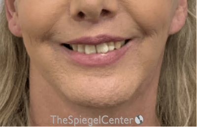 Chin Augmentation Before & After Gallery - Patient 191101 - Image 2