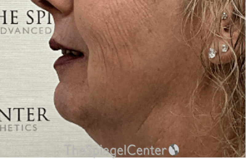 Chin Augmentation Before & After Gallery - Patient 191101 - Image 3