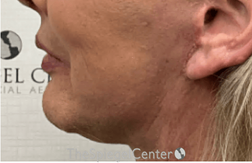 Chin Augmentation Before & After Gallery - Patient 191101 - Image 4