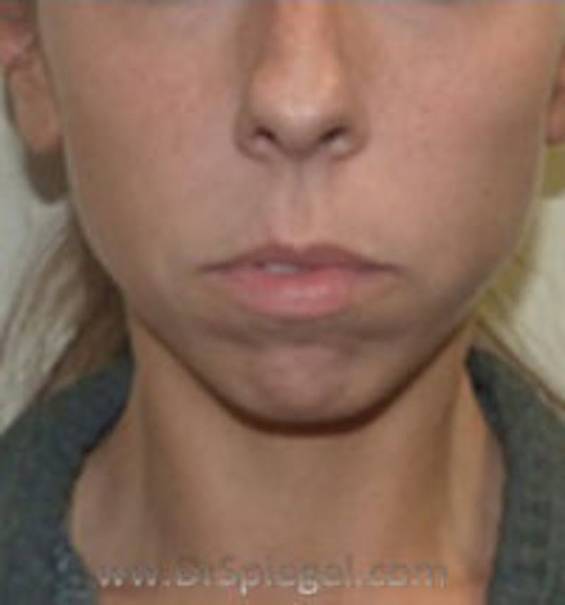 Chin Augmentation Before & After Gallery - Patient 186908 - Image 1