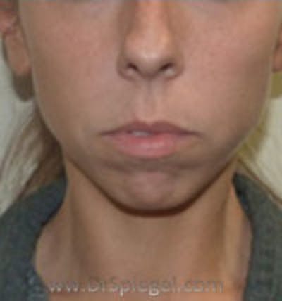 Chin Augmentation Before & After Gallery - Patient 186908 - Image 1