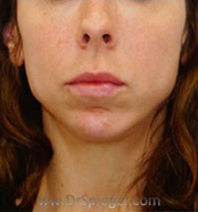 Chin Augmentation Before & After Gallery - Patient 186908 - Image 2