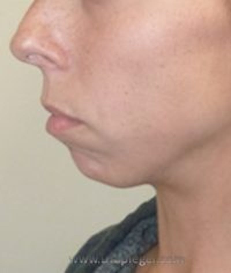 Chin Augmentation Before & After Gallery - Patient 186908 - Image 3
