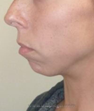 Chin Augmentation Before & After Gallery - Patient 186908 - Image 3