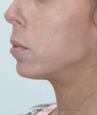 Chin Augmentation Before & After Gallery - Patient 186908 - Image 4