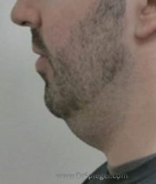 Chin Augmentation Before & After Gallery - Patient 122122 - Image 1