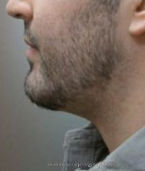 Chin Augmentation Before & After Gallery - Patient 122122 - Image 2