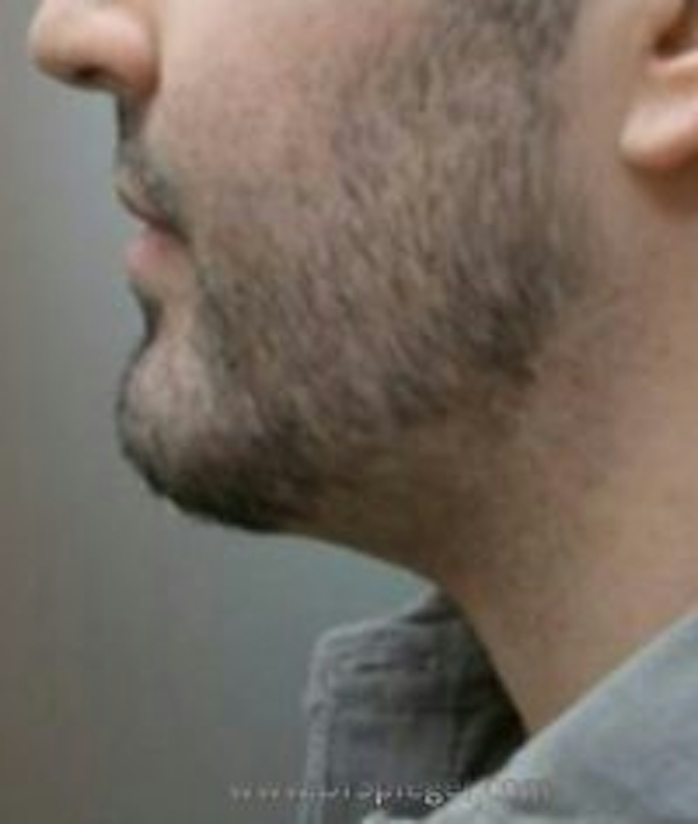 Chin Implant in Boston Before and After Photos