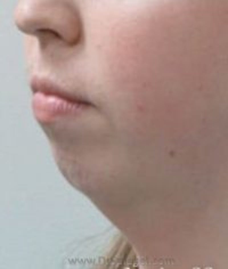 Chin Augmentation Before & After Gallery - Patient 408369 - Image 1