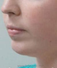Chin Augmentation Before & After Gallery - Patient 408369 - Image 2