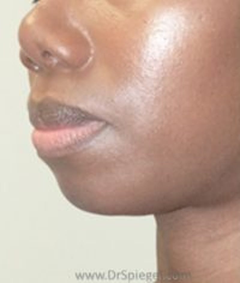 Chin Augmentation Before & After Gallery - Patient 285093 - Image 1