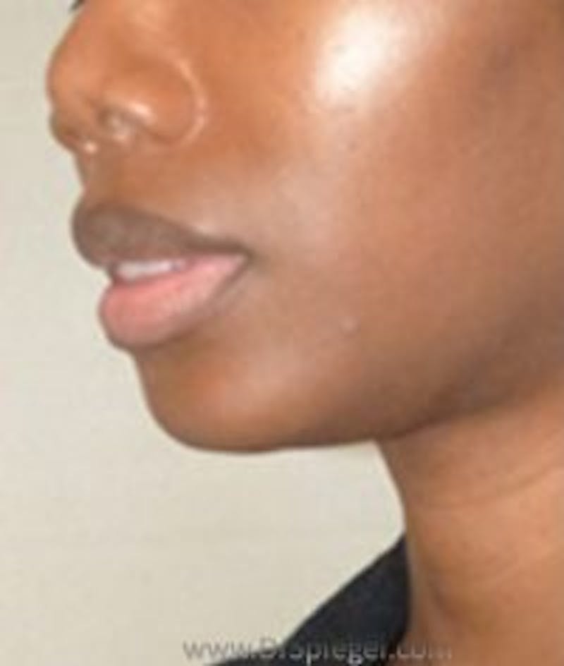 Chin Augmentation Before & After Gallery - Patient 285093 - Image 2