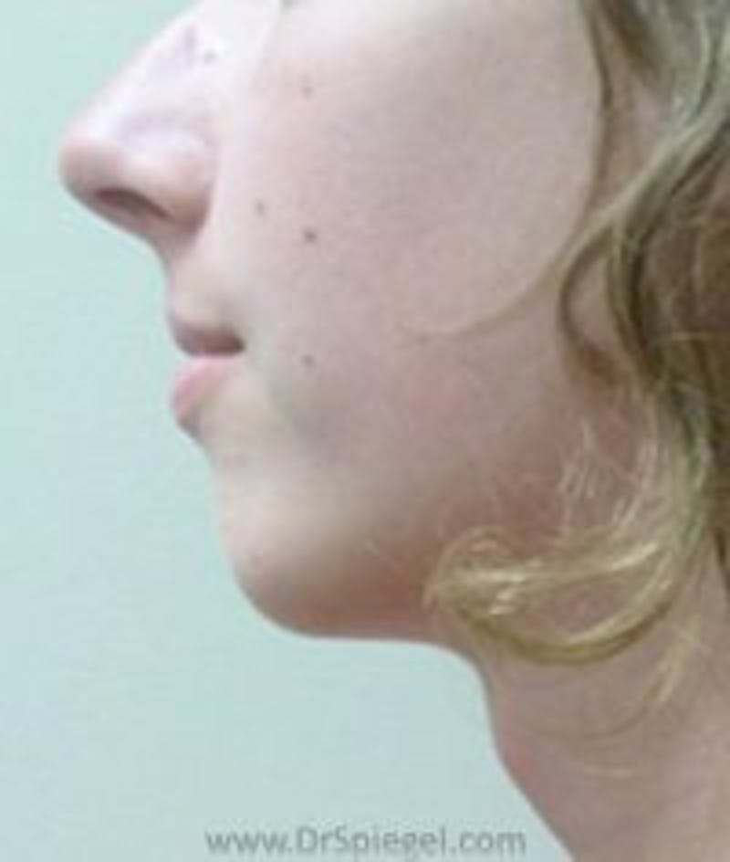 Chin Augmentation Before & After Gallery - Patient 409479 - Image 1