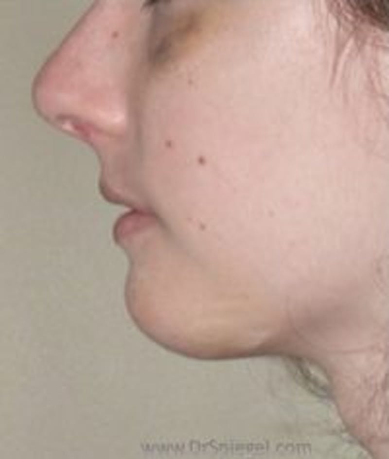 Chin Augmentation Before & After Gallery - Patient 409479 - Image 2